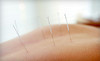 Slycord Acupuncture Coupons Bellevue, Washington Deals