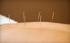 Acupuncture And Holistic Medicine Healing Center Coupons Osprey, Florida Deals