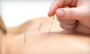 Acupuncture Center Coupons Overland Park, Kansas Deals