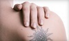 Precision Laser Tattoo Removal Coupons Toronto, Ontario Deals